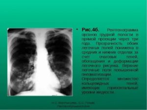 Всвязи с чем может быть снижена пневматизация лёгочной ткани?
