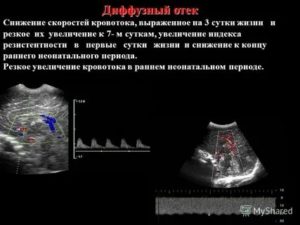 Снижение скорости кровотока