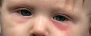 Красная опухшая складка под глазом у ребенка