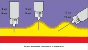 Можно ли колоть мильгамму инсулиновым шприцом?