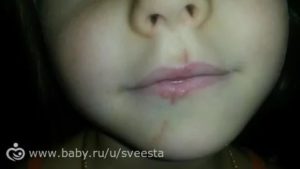 У ребенка рассечена губа, надо ли зашивать?