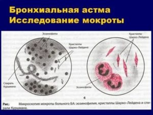 Кашель с мокротой, повышены эозинофилы