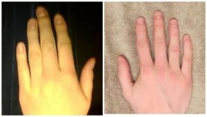 Онемение пальца после пореза