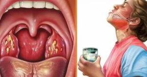 Боль в горле неделю, нужны ли антибиотики?