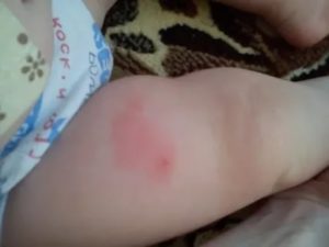 Болит рука после прививки от столбняка и дифтерии