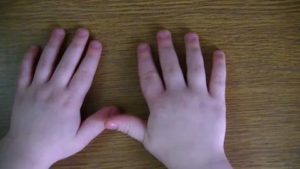 У ребенка опухли пальцы