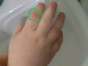 У ребёнка мягкая шишка на пальце