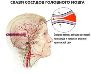 Спазм сосудов шеи при беременности