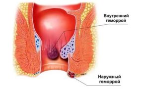 Шишка между влагалищем и анусом