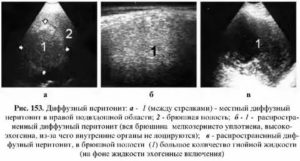 Можно ли на узи увидеть перитонит?