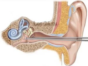 Что такое санация уха?