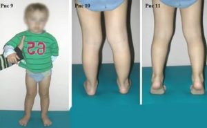 Ребенок 2,5 года стал косолапить на одну ногу