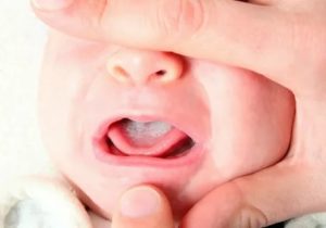 Сухость во рту у новорожденного