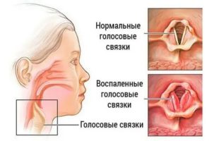 Ларингит не проходит после лечения