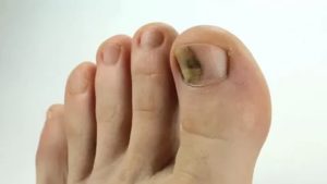 Травма ногтей на больших пальцах ног