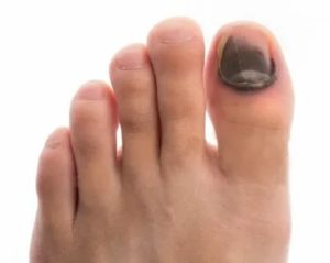 Травма ногтей на больших пальцах ног
