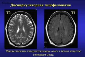 Гиперинтенсивные очаги в головном мозге