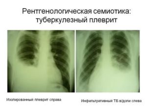 Заразен ли туберкулезный плеврит?