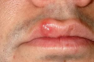 Сколько дней заразен герпес на губе?