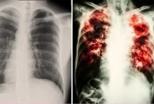 Может ли активная форма туберкулеза протекать без симптомов?