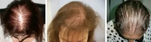 Могут ли выпадать волосы от проблем с поджелудочной?