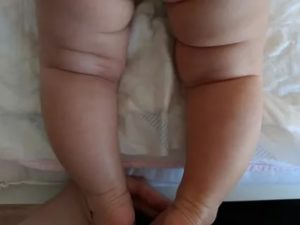 Почему не симметричны складочки на ножках у ребёнка?