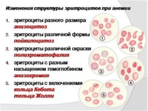 У девочки 1,2 года обнаружили анизоцитоз, что нам сейчас делать?