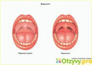 У ребенка температура 5-й день, красное горло