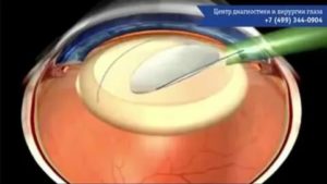 Сколько можно смотреть телевизор после операции на катаракту?