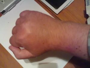 Болит и распухла рука после укола шипом растения