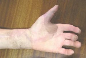 Онемение руки после удара током и операции