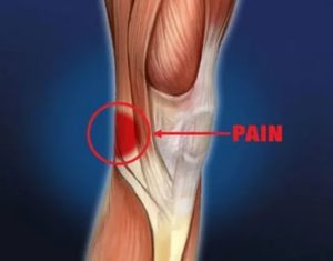 Боль под коленом при выпрямлении