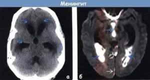 Подозрения на менингит на основе МРТ, симптомов нет