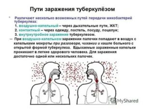 Передается ли туберкулёз через поцелуй?