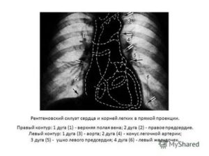 Склероз аорты на флюорографии