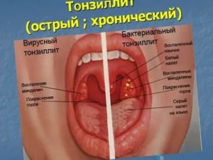 Большие проблемы от последствий хронического тонзиллита, прошу помощи