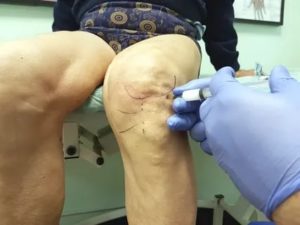 После  укола в бедро заболело колено, чем опасно?