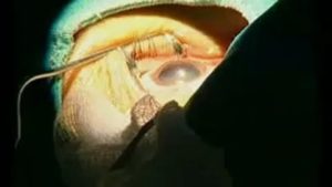 Сколько можно смотреть телевизор после операции на катаракту?