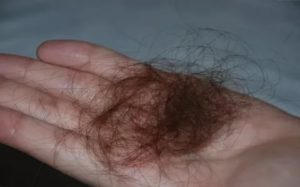 Поликистоз, выпадают волосы - клоками