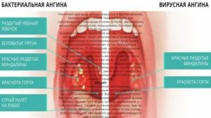 Боль в горле, температура 37,4 ~ 37,6