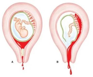 Забеременела со спиралью, аборт