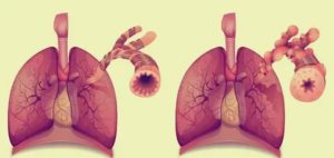 Легкие вздуты при астме, это опасно?