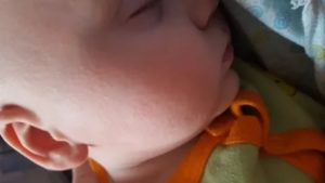 У ребенка на лице мелкая бесцветная сыпь