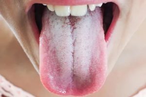 Налет на языке, жжение языка после курса антибиотиков