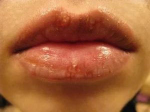 Процедура увеличения губ при герпесе