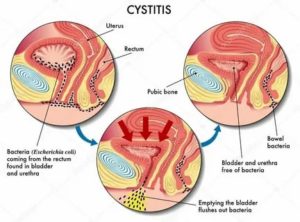 Цистит после каждого ПА с мужем