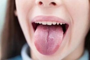 Налет на языке, жжение языка после курса антибиотиков