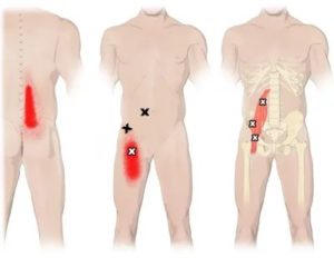 Боли в подвздошно-поясничной мышце