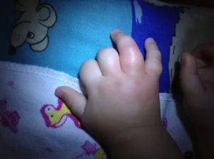 У ребенка опухли пальцы