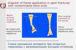 Дополнение к вопросу Вопросы по лечению открытого перелома (фото)